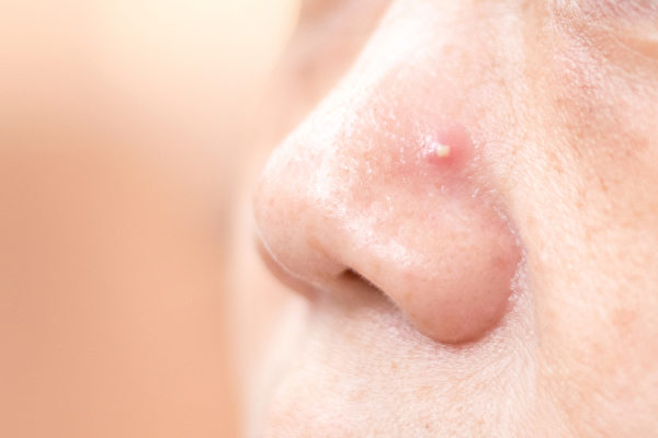 痤疮也就是青春痘，是一种慢性皮肤病，中西医如何治疗？(Shutterstock)